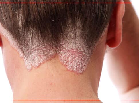 “الصدفية” … اضطراب جلدي يتسبب في تشوهات جسدية