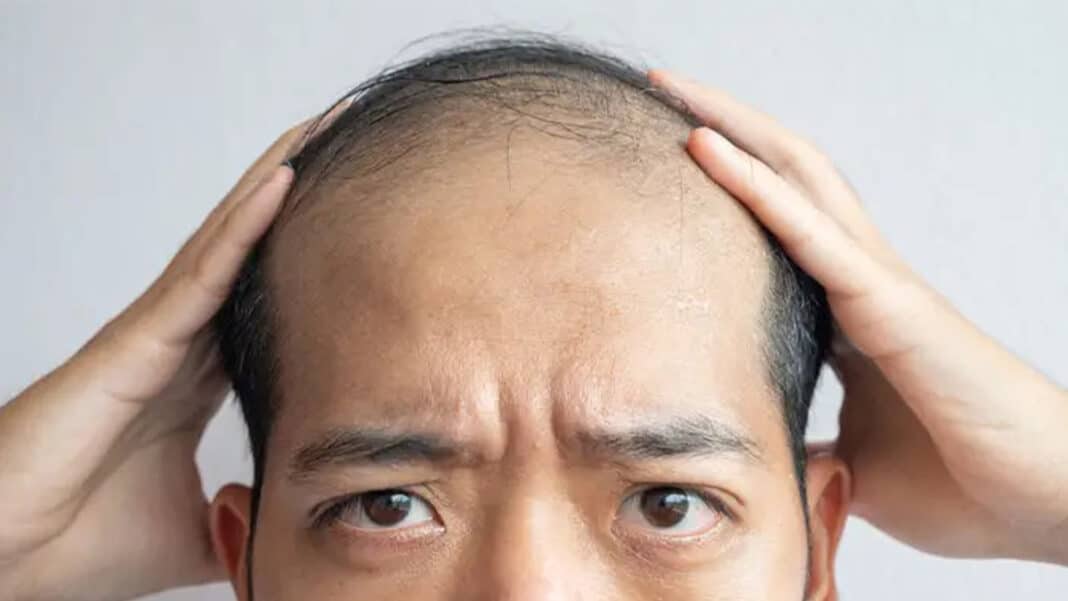 ​يحدث تساقط الشعر عندما تتعطل دورة نمو الشعر لأسباب عدة - إنترنيت